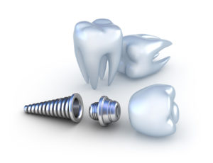 Alliance dentistry offers a dental implant in Cary NC for diabetic patients
