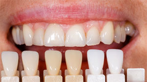 Teeth Whitening Morrisville