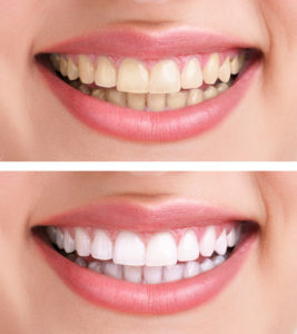 tooth whitening Cary, NC