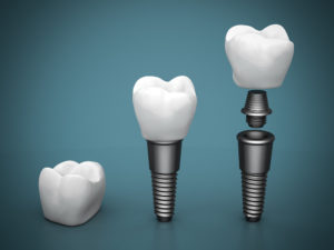 dental implants Morrisville NC