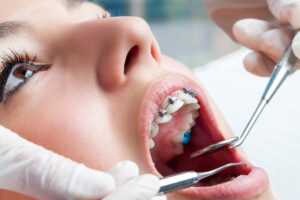 Dentist Apex in North Carolina