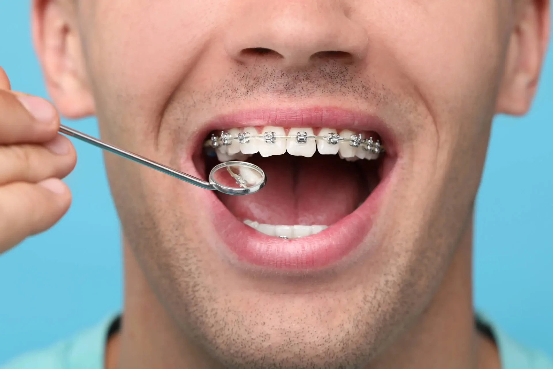 Family Dentist in Apex NC Explains Best Ages for Braces