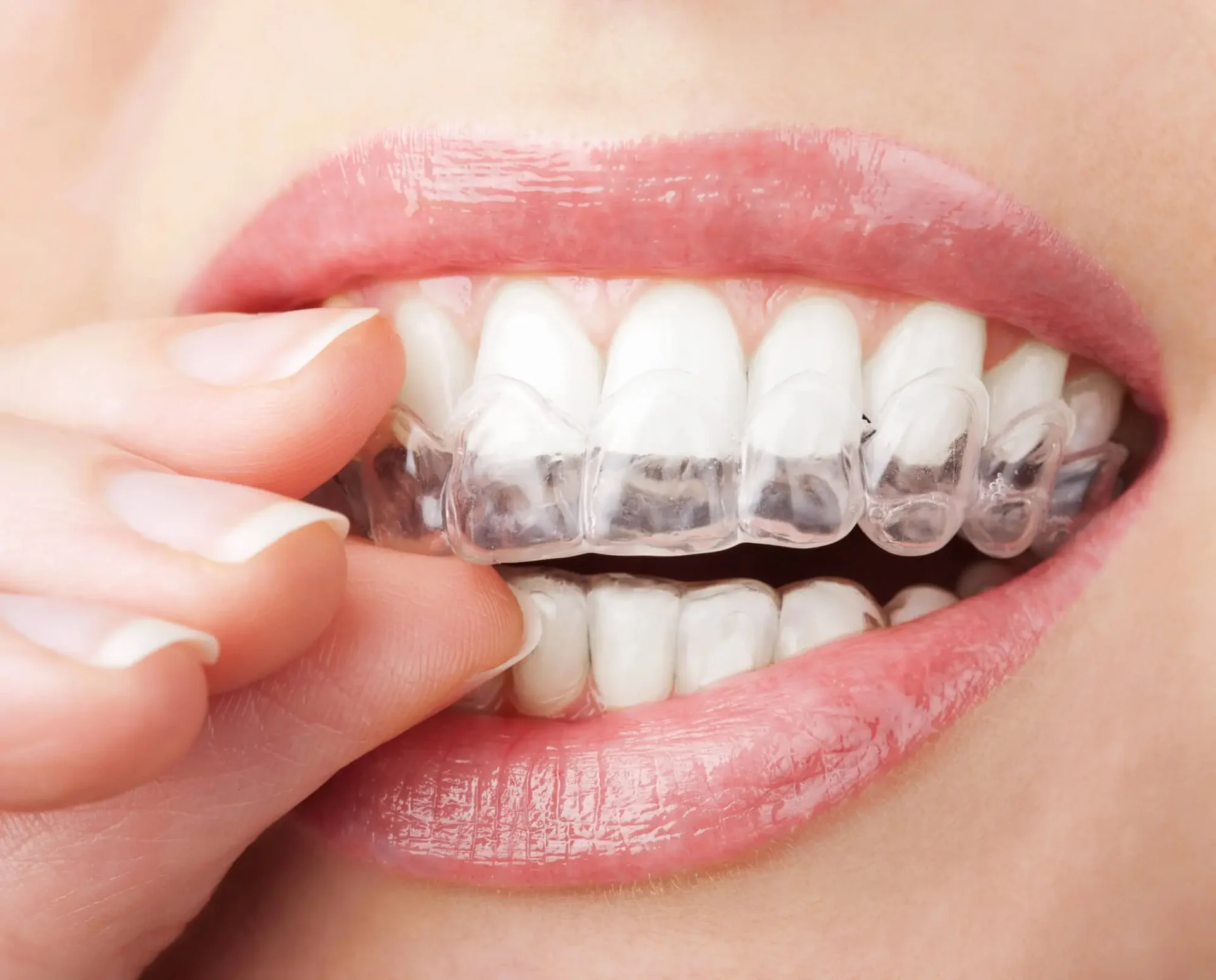 Teeth Whitening in Apex NC