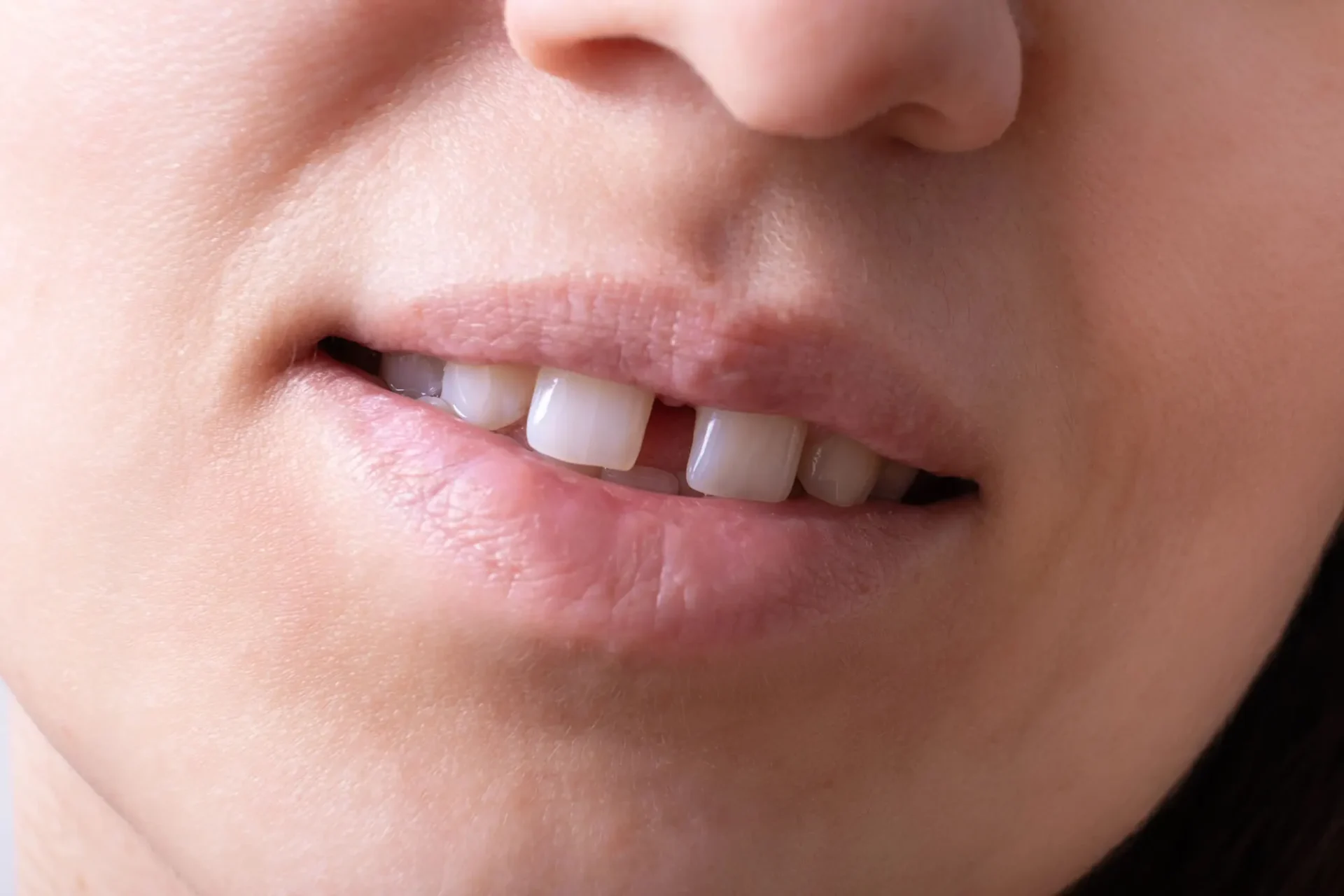 Fix Spaces Between front Teeth with Dental Veneers in Cary NC