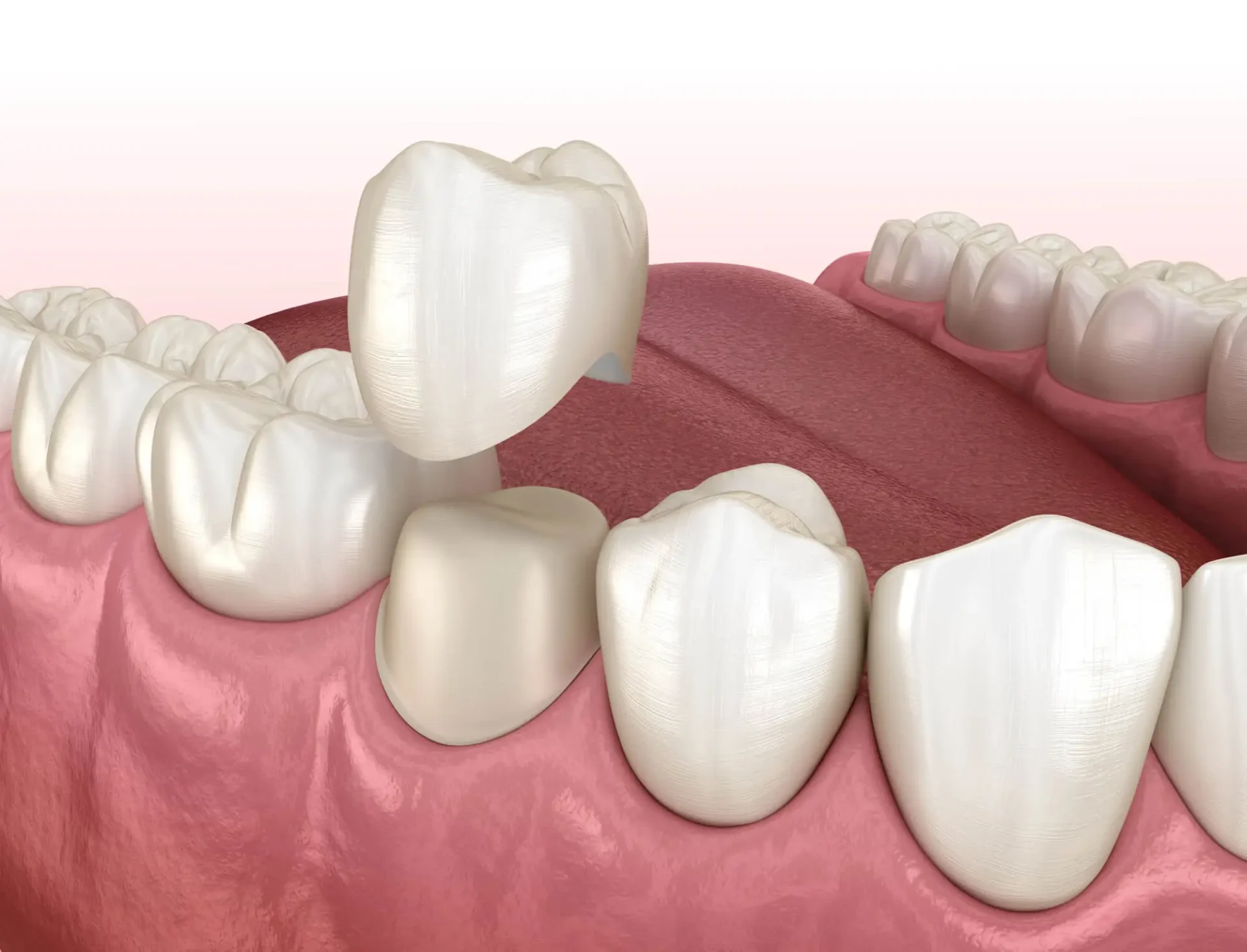 Illustration-of-Dental-Crowns-in-Cary-NC