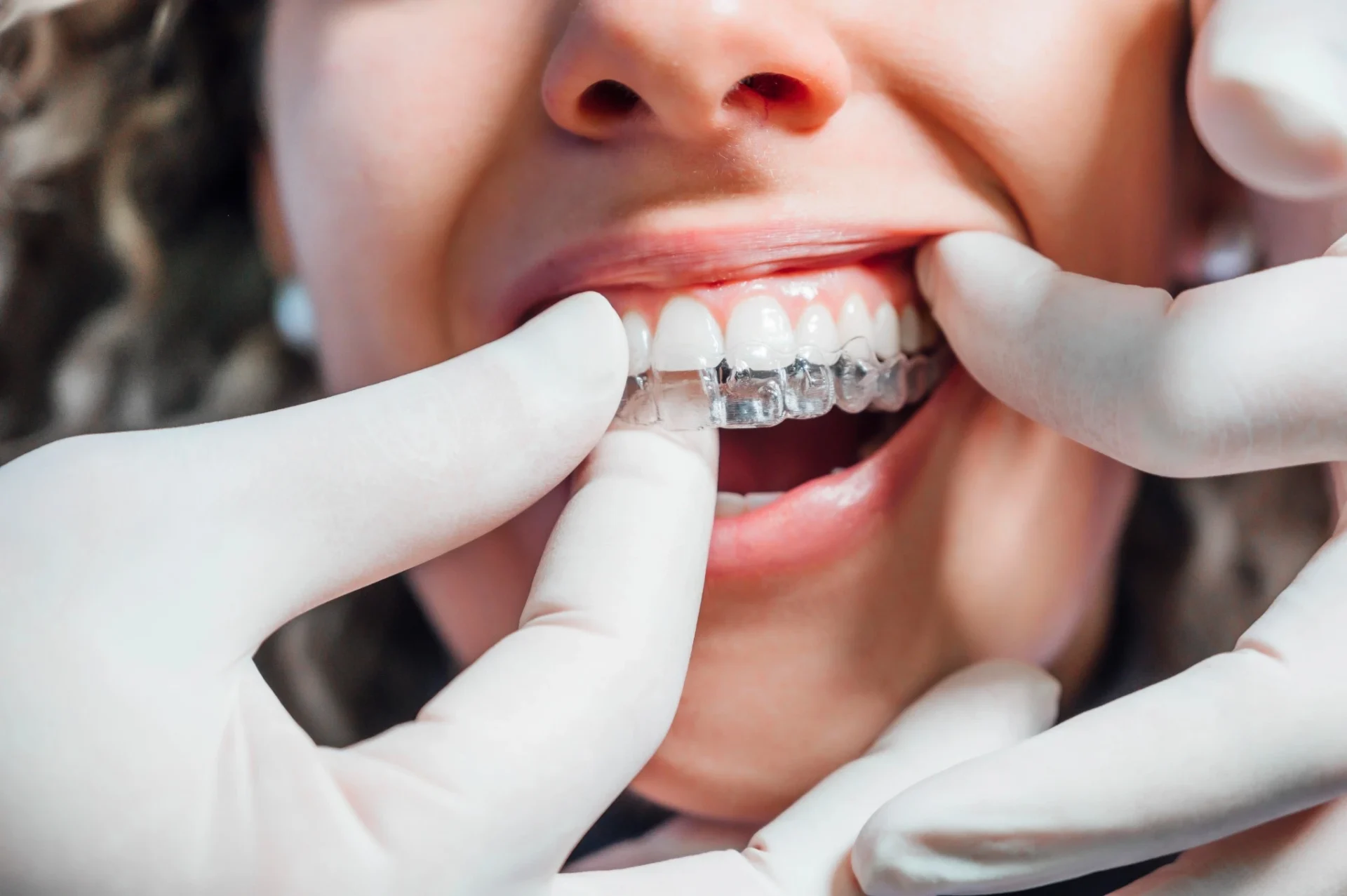 invisalign cary nc fitting aligners