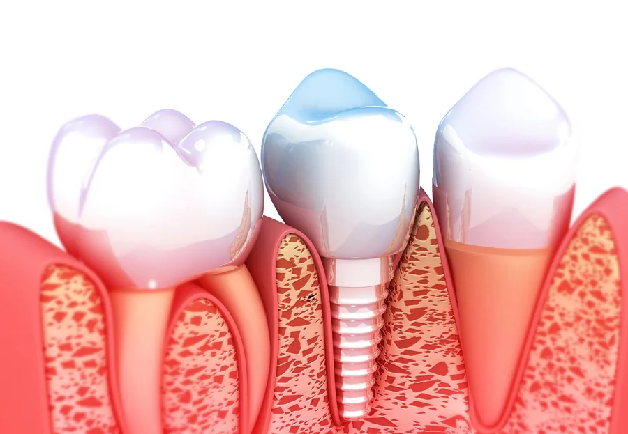 dental-implants-cary-nc-implant-procedure-model