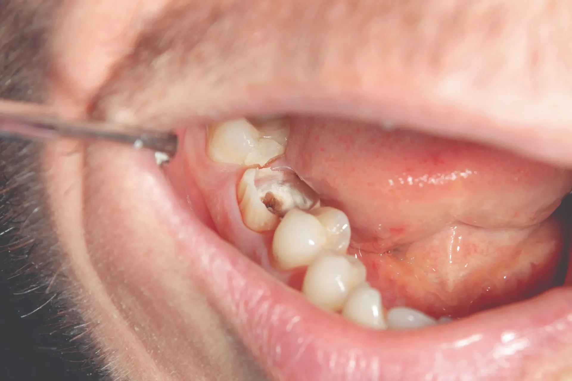 root-canal-cary-nc-tooth-decay-examination